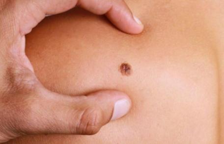 Ce faci când ți se rupe o aluniță