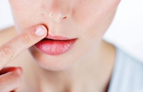 Remedii naturale pentru stomatite