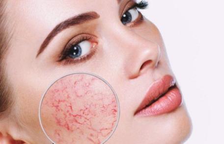 Roșeață pe față: care sunt cauzele