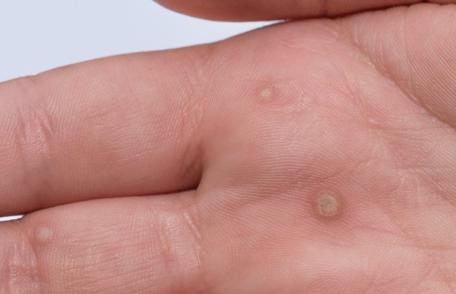 Cum puteți elimina un neg fără durere