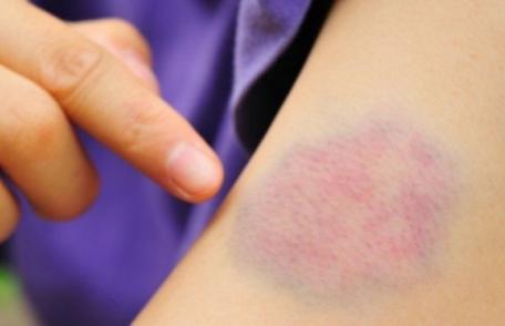 Semnele care anunță leucemia: care sunt persoanele cu risc