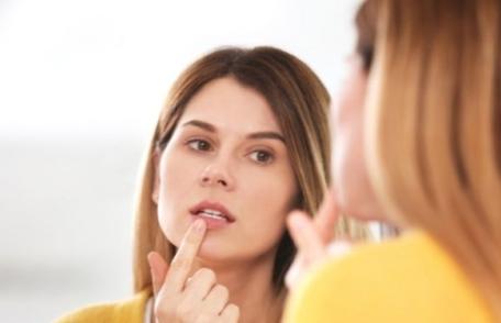 Opt trucuri pentru a scăpa rapid de herpes