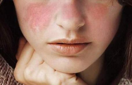 Boala care poate afecta multe părți ale corpului, inclusiv articulațiile, pielea, rinichii, inima