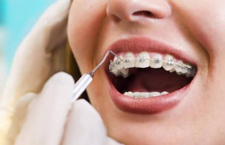 Vârsta maximă până la care sunt recomandate aparatele dentare