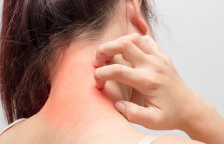 Remediu naturist care tratează iritațiile și eczemele