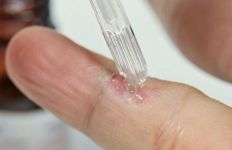 Cum puteți elimina un neg fără durere