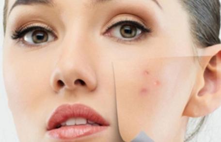 Probleme de sănătate ascunse de coșurile de pe față