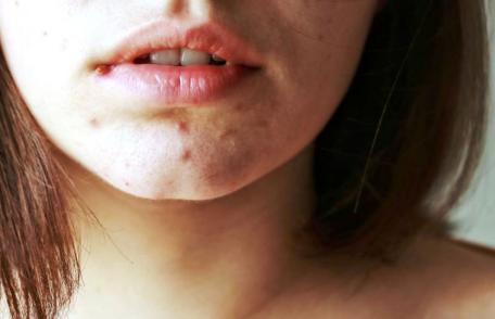 Efectele consumului de zahăr în exces