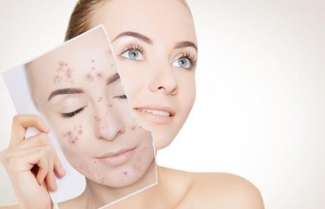 Plante care ajută tinerii să țină acneea sub control