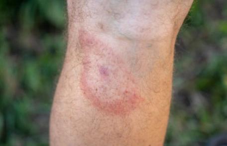 Câteva semne de avertizare că aveți boala Lyme transmisă de căpușe