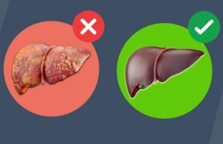 Cum poți detoxifia ficatul gras folosind un singur ingredient? 