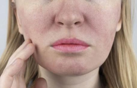 Rozaceea - ce este şi cum se manifestă