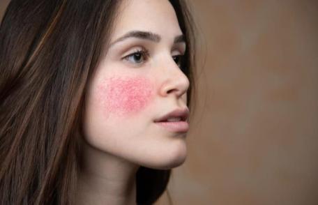 Roșeață pe față: care sunt cauzele