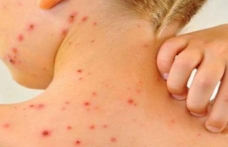 Ministerul Sănătății a declarat epidemie de rujeolă la nivel național. Creștere îngrijorătoare a cazurilor de infectare