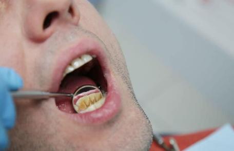 Sfaturi pentru a elimina tartrul dentar în mod natural