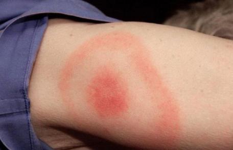 Semne de avertizare că ai boala Lyme transmisă de căpușe