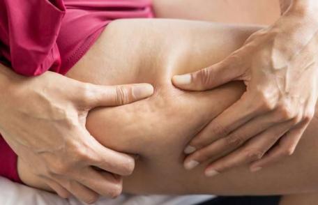 Dieta care ne poate scăpa de celulită