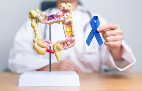 Polipii de colon, sursa de cancer. Cât de des trebuie făcută colonoscopia