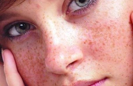 Scapă de pistrui cu cele mai bune remedii naturale!