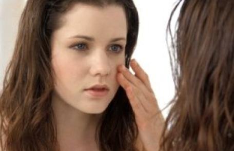 Acneea îţi poate distruge viaţa. Află care este tratamentul minune