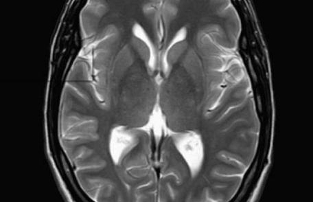 Incredibil! Vezi ce au descoperit medicii în creierul unei femei
