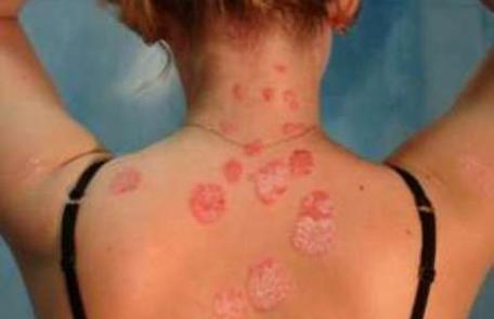 Consultații gratuite pentru pacienții care suferă de psoriazis în perioada 1 aprilie-30 iunie