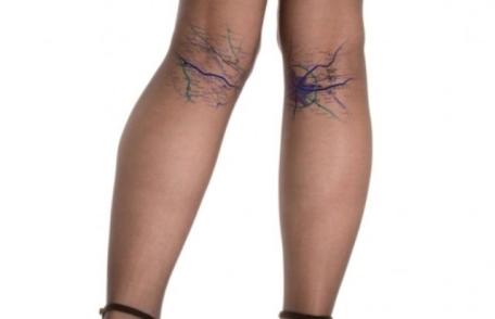 Varicele, o boală tot mai răspândită în rândul tinerelor. Cum previi această afecţiune inestetică