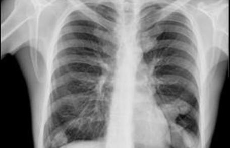 Medicii au văzut radiografia şi au încremenit. Pacienta: „L-am înghiţit de teama prietenului meu”