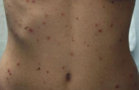 Alertă! Varicela face ravagii printre adulţi - cum previi boala şi ce complicaţii are