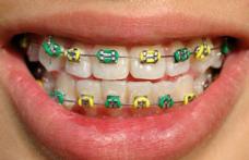 Dinții copiilor pot fi îndreptați începând de la 5-6 ani