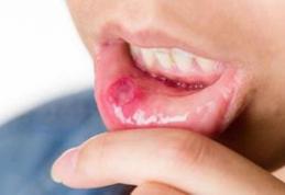Atenție! Aftele bucale pot anunța lipsa unor vitamine, imunitate scăzută dar și boli grave