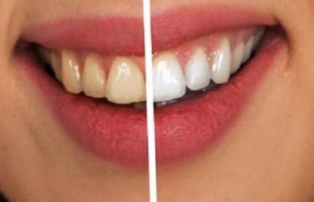 Patru modalități naturale pentru albirea dinților