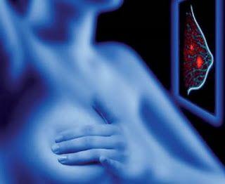 Cancerul de sân: Ce trebuie să ştii despre el