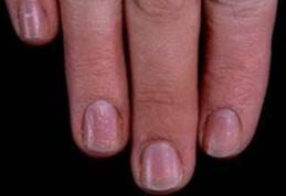 Probleme de sănătate pe care le pot indica unghiile