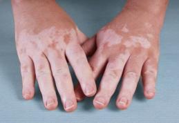 Cum apare și cum trebuie să ne îngrijim atunci când suferim de Vitiligo
