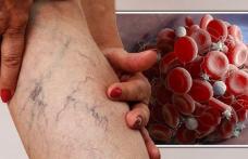Simptome care vă informează despre prezenta un cheag de sânge în corp