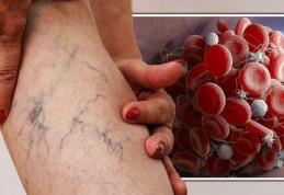 Simptome care vă informează despre prezenta un cheag de sânge în corp