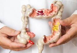 Sindromul de colon iritabil: cum vă liniștiți abdomenul