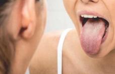 Ce afecțiune poți avea dacă ai limba încărcată de depozite albicioase sau gălbui