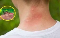 Cum tratăm mușcăturile de țânțari
