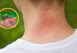Cum tratăm mușcăturile de țânțari