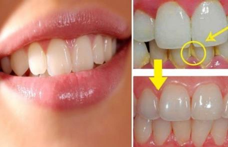 Sfaturi pentru a elimina tartrul dentar în mod natural