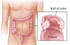 Cancerul de colon poate fi prevenit din adolescenţă cu ajutorul unui aliment