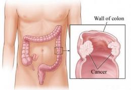 Cancerul de colon poate fi prevenit din adolescenţă cu ajutorul unui aliment