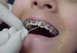 Aparatul dentar – necesitate sau capriciu?