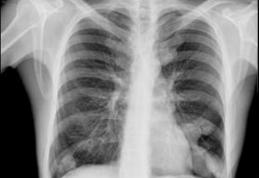 Medicii au văzut radiografia şi au încremenit. Pacienta: „L-am înghiţit de teama prietenului meu”