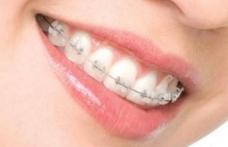 Până la ce vârstă poți purta aparat dentar? Alfă de la specialiști