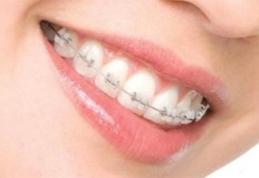 Până la ce vârstă poți purta aparat dentar? Alfă de la specialiști