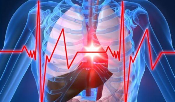 infarct