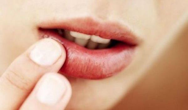 Cum să scapi de herpes